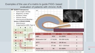 32
Examples of the use of a matrix to guide FIGO- based
evaluation of patients with chronic AUB.
 