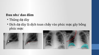 Đau nh dao đâmư
• Th ng d dàyủ ạ
• D ch d dày là d ch toan ch y vào phúc m c gây b ngị ạ ị ả ạ ỏ
phúc m cạ
 