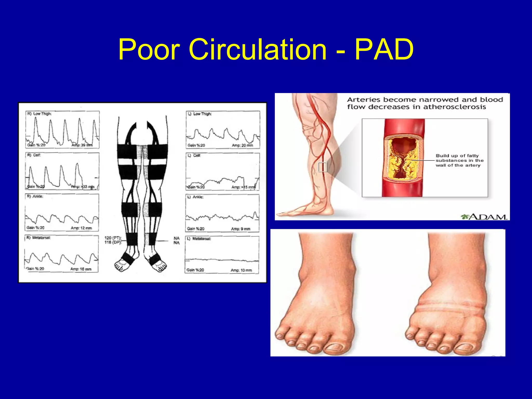Poor Circulation - PAD 