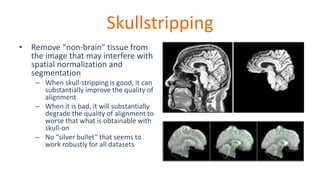 Skullstripping
• Remove “non-brain” tissue from
the image that may interfere with
spatial normalization and
segmentation
– When skull-stripping is good, it can
substantially improve the quality of
alignment
– When it is bad, it will substantially
degrade the quality of alignment to
worse that what is obtainable with
skull-on
– No “silver bullet” that seems to
work robustly for all datasets
 