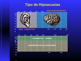 125 250 500 1000 2000 4000 8000
3000 6000
-10
0
10
20
30
40
50
60
70
125 250 500 1000 2000
4000 800
0
3000 6000
-10
0
10
20
30
40
50
60
70
80
90
10
0
AUDIOMETRIA CON ALTERACIONES
AUDIOMETRIA NORMAL
AREA CONDUCTIVA
AREA NEUROSENSORIAL
Tipo de Hipoacusias
 