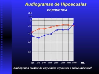 0
20
40
60
80
250 500 1000 2000 3000 4000 Hz.
dB
Audiogramas de Hipoacusias
Audiograma medico de empelados expuestos a ruido industrial
CONDUCTIVA
-10
6000125
O
O O
O
O O O O
X
X
X
X
X X X
X
 