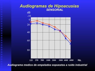 0
20
40
60
80
250 500 1000 2000 3000 4000 Hz.
dB
Audiogramas de Hipoacusias
Audiograma medico de empelados expuestos a ruido industrial
SENSORIAL
-10
6000125
O O
O
O
O
O
O
O
X X
X
X
X
X
X
X
 