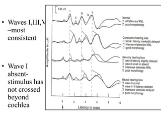 • Waves I,III,V
–most
consistent
• Wave I
absent-
stimulus has
not crossed
beyond
cochlea
 