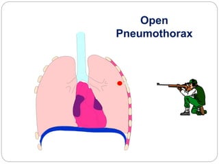 Open
Pneumothorax
 
