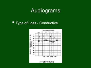 • Type of Loss - Conductive
Audiograms
 