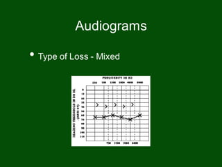 • Type of Loss - Mixed
Audiograms
 