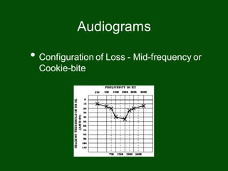 • Configuration of Loss - Mid-frequency or
Cookie-bite
Audiograms
 