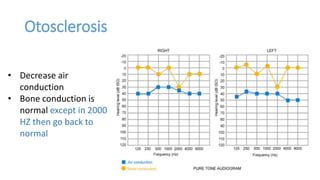 Otosclerosis
• Decrease air
conduction
• Bone conduction is
normal except in 2000
HZ then go back to
normal
 