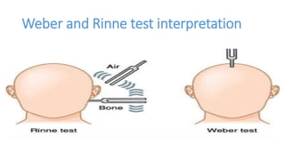 Weber and Rinne test interpretation
 