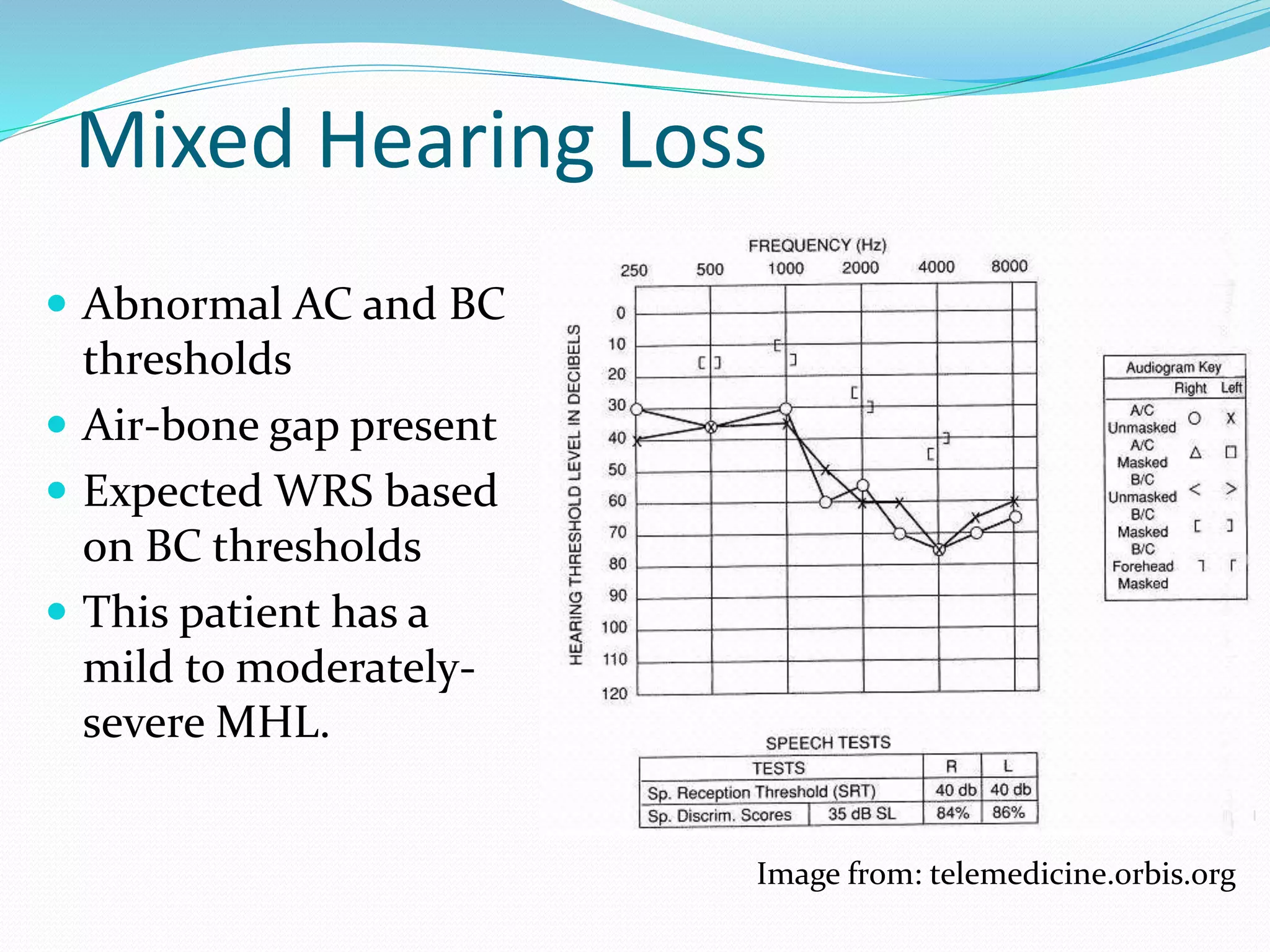 Mixed Hearing Loss
 Abnormal AC and BC
thresholds
 Air-bone gap present
 Expected WRS based
on BC thresholds
 This patient has a
mild to moderately-
severe MHL.
Image from: telemedicine.orbis.org
 