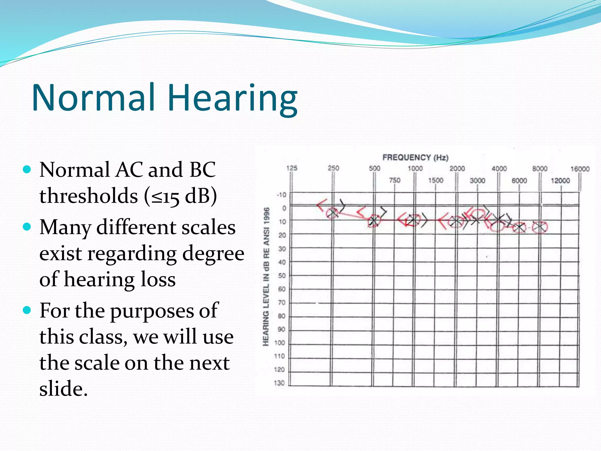 Normal Hearing
 Normal AC and BC
thresholds (≤15 dB)
 Many different scales
exist regarding degree
of hearing loss
 For the purposes of
this class, we will use
the scale on the next
slide.
 