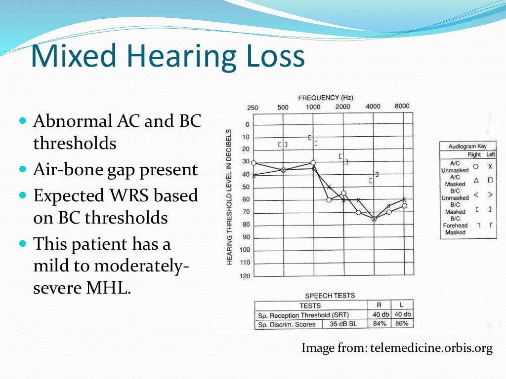 Audiogram interpretation