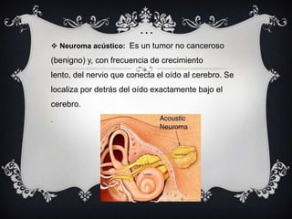 …

 Neuroma acústico: Es un tumor no canceroso

(benigno) y, con frecuencia de crecimiento

lento, del nervio que conecta el oído al cerebro. Se
localiza por detrás del oído exactamente bajo el
cerebro.
.

 