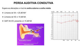  Limiares de VA: > 25 dB NA*
 Limiares de VO: ≤ 15 dB NA
 GAP VA-VO: presente e ≥ 15 dB NA
PERDA AUDITIVA CONDUTIVA
Sugere-se alterações a nível de orelha externa e orelha média
 