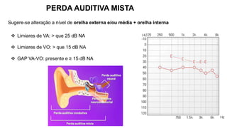  Limiares de VA: > que 25 dB NA
 Limiares de VO: > que 15 dB NA
 GAP VA-VO: presente e ≥ 15 dB NA
PERDA AUDITIVA MISTA
Sugere-se alteração a nível de orelha externa e/ou média + orelha interna
 