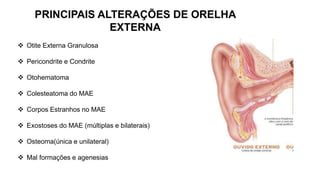  Otite Externa Granulosa
 Pericondrite e Condrite
 Otohematoma
 Colesteatoma do MAE
 Corpos Estranhos no MAE
 Exostoses do MAE (múltiplas e bilaterais)
 Osteoma(única e unilateral)
 Mal formações e agenesias
PRINCIPAIS ALTERAÇÕES DE ORELHA
EXTERNA
 