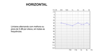 HORIZONTAL
Limiares alternando com melhora ou
piora de 5 dB por oitava, em todas as
frequências.
 