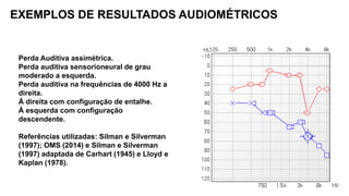 Perda Auditiva assimétrica.
Perda auditiva sensorioneural de grau
moderado a esquerda.
Perda auditiva na frequências de 4000 Hz a
direita.
À direita com configuração de entalhe.
À esquerda com configuração
descendente.
Referências utilizadas: Silman e Silverman
(1997); OMS (2014) e Silman e Silverman
(1997) adaptada de Carhart (1945) e Lloyd e
Kaplan (1978).
EXEMPLOS DE RESULTADOS AUDIOMÉTRICOS
 