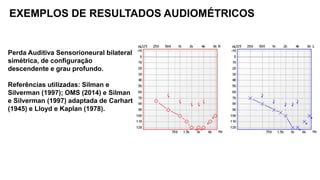 EXEMPLOS DE RESULTADOS AUDIOMÉTRICOS
Perda Auditiva Sensorioneural bilateral
simétrica, de configuração
descendente e grau profundo.
Referências utilizadas: Silman e
Silverman (1997); OMS (2014) e Silman
e Silverman (1997) adaptada de Carhart
(1945) e Lloyd e Kaplan (1978).
 