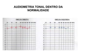 AUDIOMETRIA TONAL DENTRO DA
NORMALIDADE
 