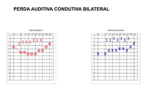 PERDA AUDITIVA CONDUTIVA BILATERAL
 