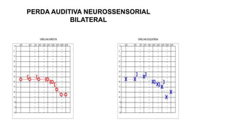 PERDA AUDITIVA NEUROSSENSORIAL
BILATERAL
 