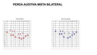 PERDA AUDITIVA MISTA BILATERAL
 
