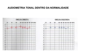 AUDIOMETRIA TONAL DENTRO DA NORMALIDADE
 