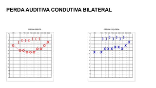 PERDA AUDITIVA CONDUTIVA BILATERAL
 