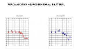 PERDA AUDITIVA NEUROSSENSORIAL BILATERAL
 