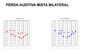 PERDA AUDITIVA MISTA BILATERAL
 