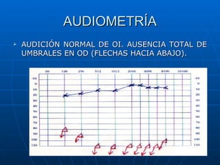 AUDIOMETRÍA
   AUDICIÓN NORMAL DE OI. AUSENCIA TOTAL DE
    UMBRALES EN OD (FLECHAS HACIA ABAJO).
 