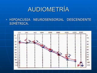 AUDIOMETRÍA
   HIPOACUSIA NEUROSENSORIAL DESCENDENTE
    SIMÉTRICA.
 