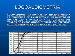 LOGOAUDIOMETRÍA
   LOGOAUDIOMETRIA NORMAL. EN TRAZO GRUESO A
    LA IZQUIERDA DE LA GRÁFICA EL PARÁMETRO DE
    NORMALIDAD Y PARALELO A SU DERECHA LOS
    TRAZOS DE AMBOS OIDOS, SIEMPRE CON CIRCULOS
    EL OIDO DERECHO Y CON CRUCES EL IZQUIERDO.
 