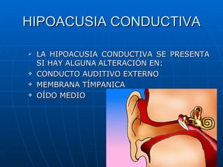 HIPOACUSIA CONDUCTIVA

   LA HIPOACUSIA CONDUCTIVA SE PRESENTA
    SI HAY ALGUNA ALTERACIÓN EN:
   CONDUCTO AUDITIVO EXTERNO
   MEMBRANA TÍMPANICA
   OÍDO MEDIO
 