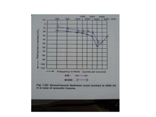 Audiological tests of hearing assessment | PPTX