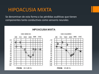 HIPOACUSIA MIXTA
Se denominan de esta forma a las pérdidas auditivas que tienen
componentes tanto conductivos como sensorio neurales
 