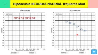 Hipoacusia NEUROSENSORIAL Izquierda Mod
M
1
 