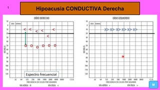 Hipoacusia CONDUCTIVA Derecha
M
1
 