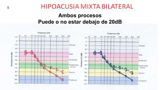 Ambos procesos
Puede o no estar debajo de 20dB
5
 