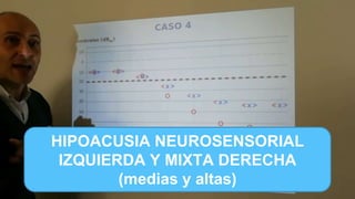 EJERCICIOS
HIPOACUSIA NEUROSENSORIAL BILATERAL
NORMAL
HIPOACUSIA NEUROSENSORIAL
IZQUIERDA Y MIXTA DERECHA
(medias y altas)
 