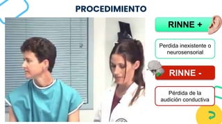 PROCEDIMIENTO
RINNE +
RINNE -
Perdida inexistente o
neurosensorial
Pérdida de la
audición conductiva
 