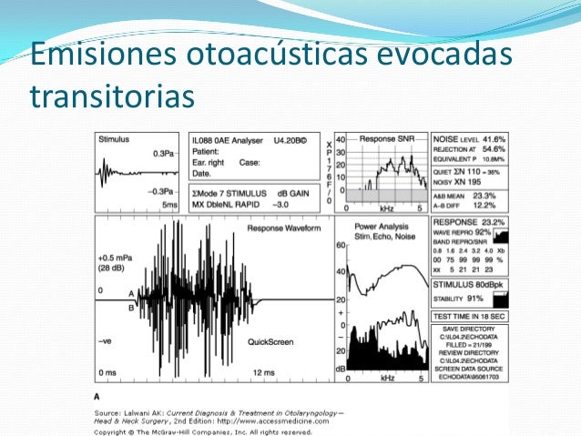 Emisiones Otoacusticas Por Producto De Distorsion