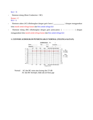Kiri = X
- Hantaran tulang (Bone Conduction = BC)
Kanan = C
Kiri = ‫כ‬
- Hantaran udara (AC) dihubungkan dengan garis lurus ( ) dengan menggunakan
tinta merah untuk telinga kanan dan biru untuk telinga kiri
- Hantaran tulang (BC) dihubungkan dengan garis putus-putus ( - - - - - - - - ) dengan
menggunakan tinta merah untuk telinga kanan dan biru untuk telinga kiri
1. CONTOH AUDIOGRAM PENDENGARAN NORMAL (TELINGA KANAN)
Normal : AC dan BC sama atau kurang dari 25 dB
AC dan BC berimpit, tidak ada air-bone gap
 