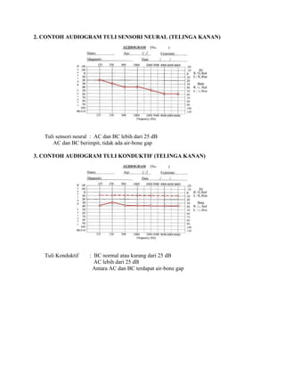 2. CONTOH AUDIOGRAM TULI SENSORI NEURAL (TELINGA KANAN)
Tuli sensori neural : AC dan BC lebih dari 25 dB
AC dan BC berimpit, tidak ada air-bone gap
3. CONTOH AUDIOGRAM TULI KONDUKTIF (TELINGA KANAN)
Tuli Konduktif : BC normal atau kurang dari 25 dB
AC lebih dari 25 dB
Antara AC dan BC terdapat air-bone gap
 