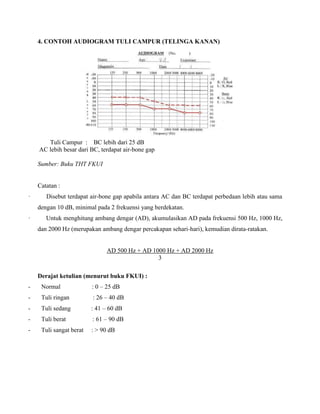 4. CONTOH AUDIOGRAM TULI CAMPUR (TELINGA KANAN)
Tuli Campur : BC lebih dari 25 dB
AC lebih besar dari BC, terdapat air-bone gap
Sumber: Buku THT FKUI
Catatan :
· Disebut terdapat air-bone gap apabila antara AC dan BC terdapat perbedaan lebih atau sama
dengan 10 dB, minimal pada 2 frekuensi yang berdekatan.
· Untuk menghitung ambang dengar (AD), akumulasikan AD pada frekuensi 500 Hz, 1000 Hz,
dan 2000 Hz (merupakan ambang dengar percakapan sehari-hari), kemudian dirata-ratakan.
AD 500 Hz + AD 1000 Hz + AD 2000 Hz
3
Derajat ketulian (menurut buku FKUI) :
- Normal : 0 – 25 dB
- Tuli ringan : 26 – 40 dB
- Tuli sedang : 41 – 60 dB
- Tuli berat : 61 – 90 dB
- Tuli sangat berat : > 90 dB
 