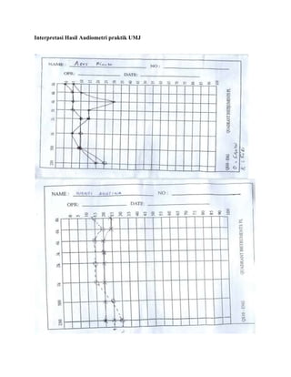 Interpretasi Hasil Audiometri praktik UMJ
 