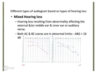 Audiometry full review | PDF