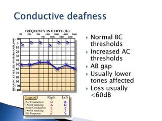 Normal BC
thresholds
 Increased AC
thresholds
 AB gap
 Usually lower
tones affected
 Loss usually
<60dB
 